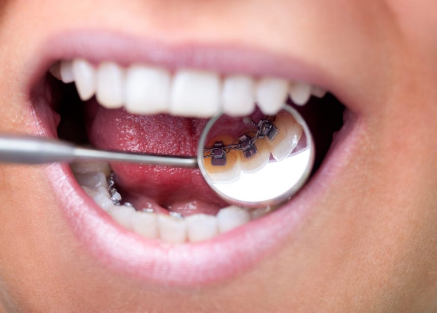 L’apparecchio per denti interno – linguale